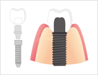 インプラント